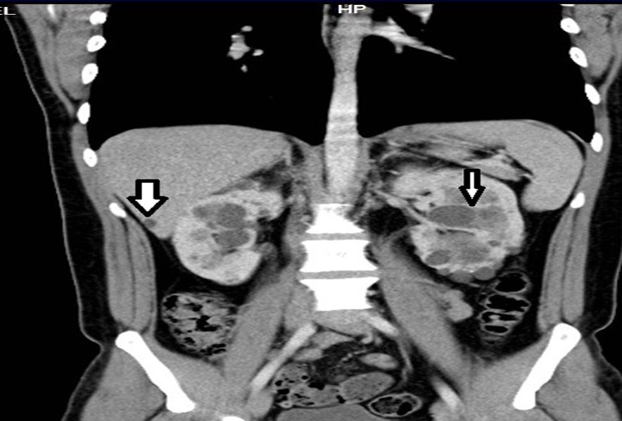 Contrast CT coronal reconstruction shows small liver cysts, kidneys are enlarged by multiple cysts.