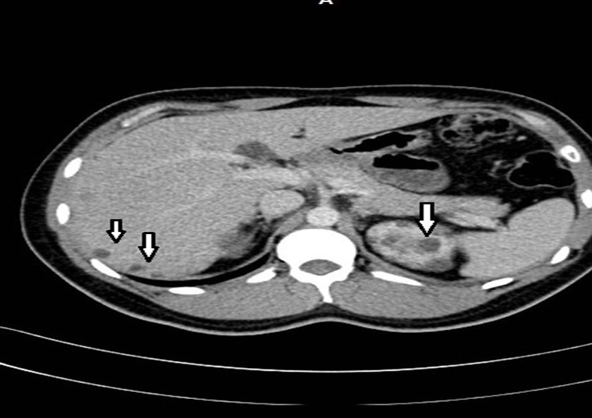 Contrast CT shows non complicated small liver cysts and multiple renal cysts.