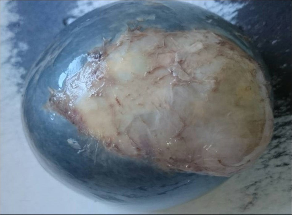 Macroscopic appearance of a splenic hydatid cyst.