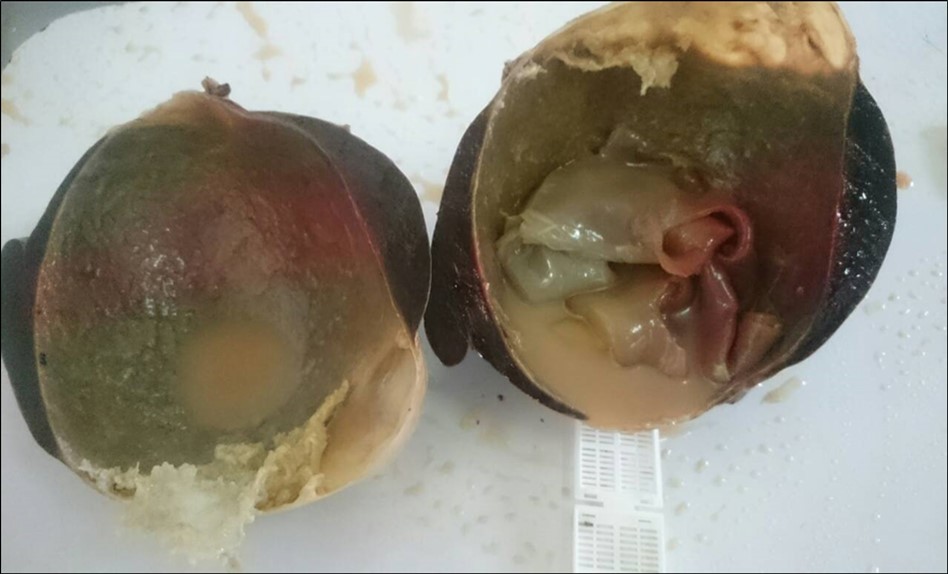 Shows cut section macroscopic of splenic hydatid cyst in centre there is hydatid membranes white.