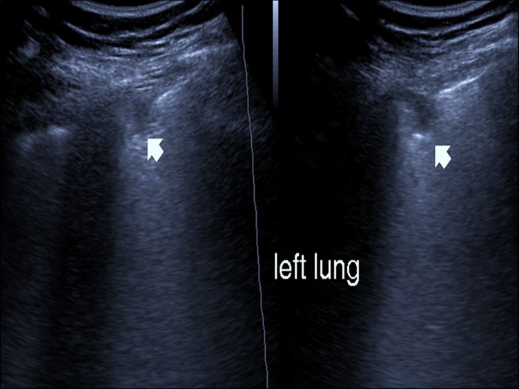 Chest ultrasound showing subpleural consolidation in  patient with Covid-19.
