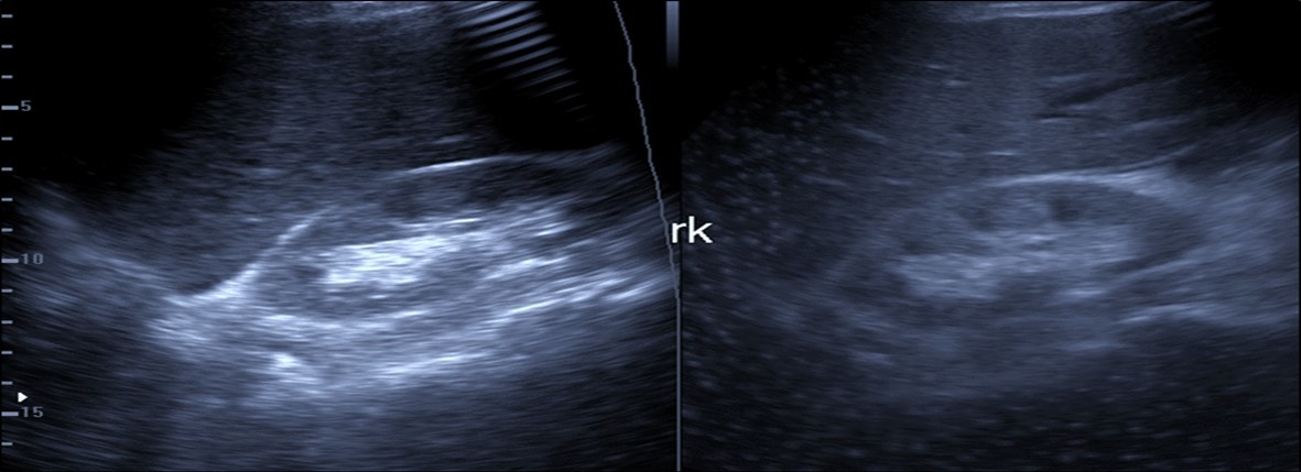 Patient with Covid-19 showing an echogenic kidney (rk) by ultrasound.