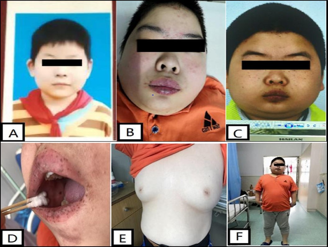 (ABCDEF) Physical signs of the patient before adrenalectomy. Cushing-like features  include moon face before surgery (BC), central obesity (F), breast development (E), spots on the face, lips, oral mucosa and skin pigmentation (CD).
