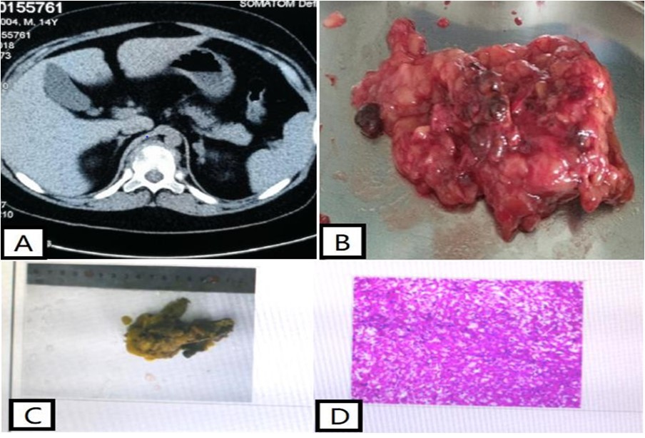 Computed tomography of the patient's adrenal gland showed multiple small nodules in the left                 adrenal inner branch and body (Figure A), considering adenoma or adrenal tuberculosis. The patient's left adrenal gland macroscopically showed a piece of grayish-yellow tissue measuring 8*6*3.5 cm, including an adrenal gland measuring 6.5*2.5*0.3 cm, with multiple small nodules of 0.2-0.7 cm in diameter attached to the surface (C). Microscopic examination of the patient's left adrenal gland showed multiple nodules in the                      adrenal cortex, without envelope, partially protruding from the adrenal gland, with clear cytoplasm and                    eosinophilic cells (D).