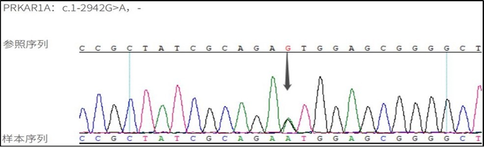DNA sequence detection: variant gene PPKAR1A variant locus C.1-2942G>A, associated disease: Cushing's syndrome (primary pigmented nodular adrenocortical disease type 1, PPNAD1).