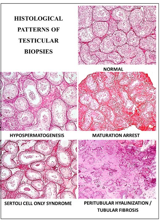Different Histological Pattern of testicular biopsy