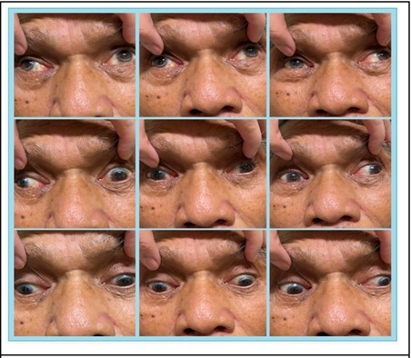 Bilateral exotropia on primary gaze exotropia and bilateral                adduction deficit during version