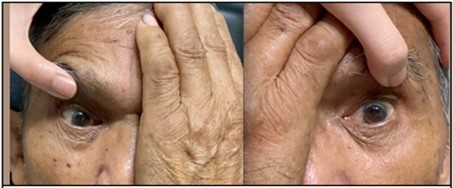 There was persistence of  bilateral adduction deficit on duction              testing