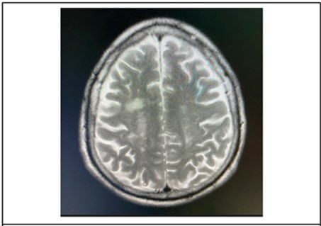 It showing T2 weighted, axial MRI scans at the level of the lateral ventricles, revealed patchy bright flair signals were noted in the subcortical white matter and periventricular area.