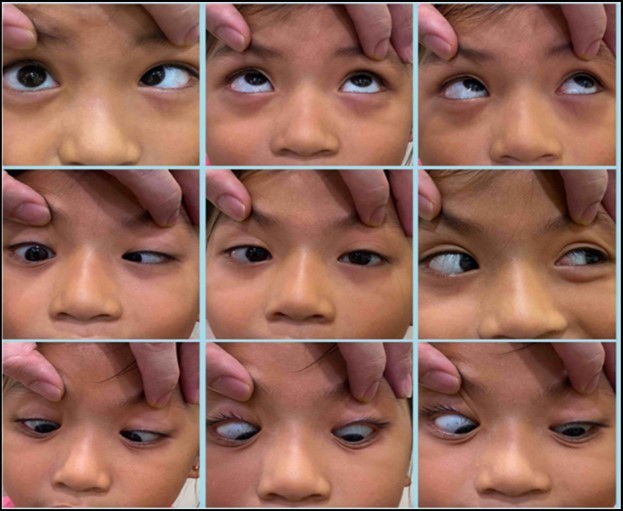 Nine gaze photo showing an inwardly deviated right eye with a full limitation on superolateral and inferolateral gazes.