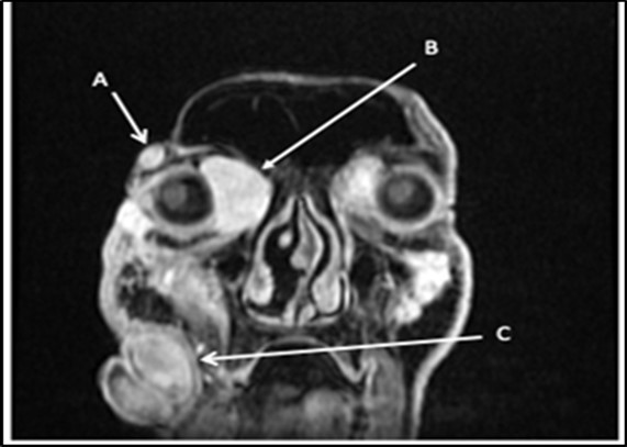 Multiple facial lesions radiologically consistent with neurofibromas. (A) 1.8X0.9X1.7cm right lateral temporal mass (B) 3.2X3X4.5 cmright medial intraorbital mass (B) (C) 8.6X7.3X6.0 cmr right nasal mass