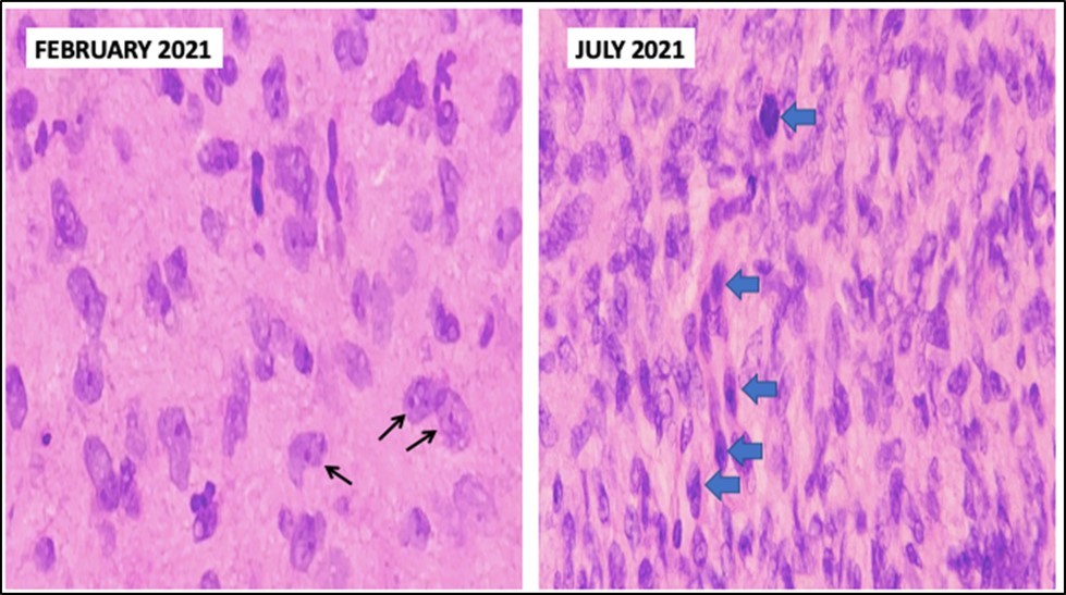 Comparison between biopsies taken five months apart.  The histopathology in the biopsy done in February shows well-spaced uniform cells (black arrows). The biopsy done in July shows cellular congestion with atypical, pleomorphic cells with increased mitotic activity (blue arrows).