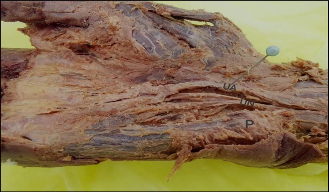Photograph of the right-hand showing trifurcation pattern of the ulnar nerve UA, ulnar artery; UN,ulnar nerve; P, pisiform bone.