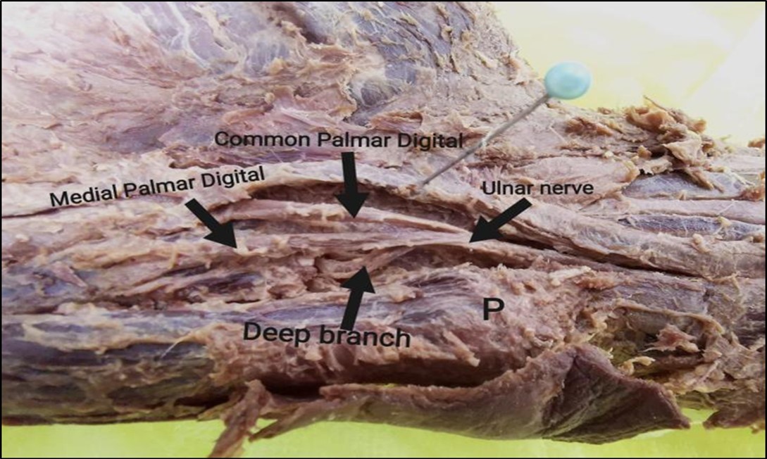 Photograph of the right-hand showing the three branches of the ulnar nerve.                      P, pisiform bone.