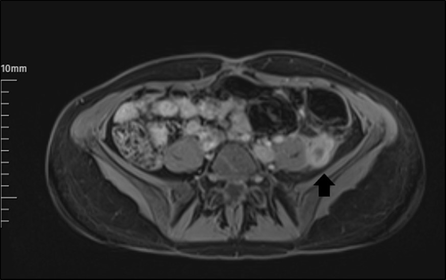 The appearance of a left ovarian vein in MRI.