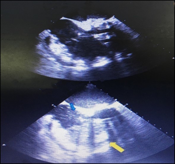The complete opacification of the right ventricle (yellow arrow) and the presence of some bubbles within the right atrium (red arrow),denoting that the tip of the drainage tube is malpositioned within the right ventricle.