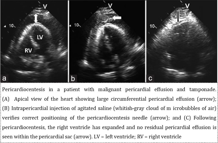 Anatomic structures to be taken care during pericardiocentesis procedure.