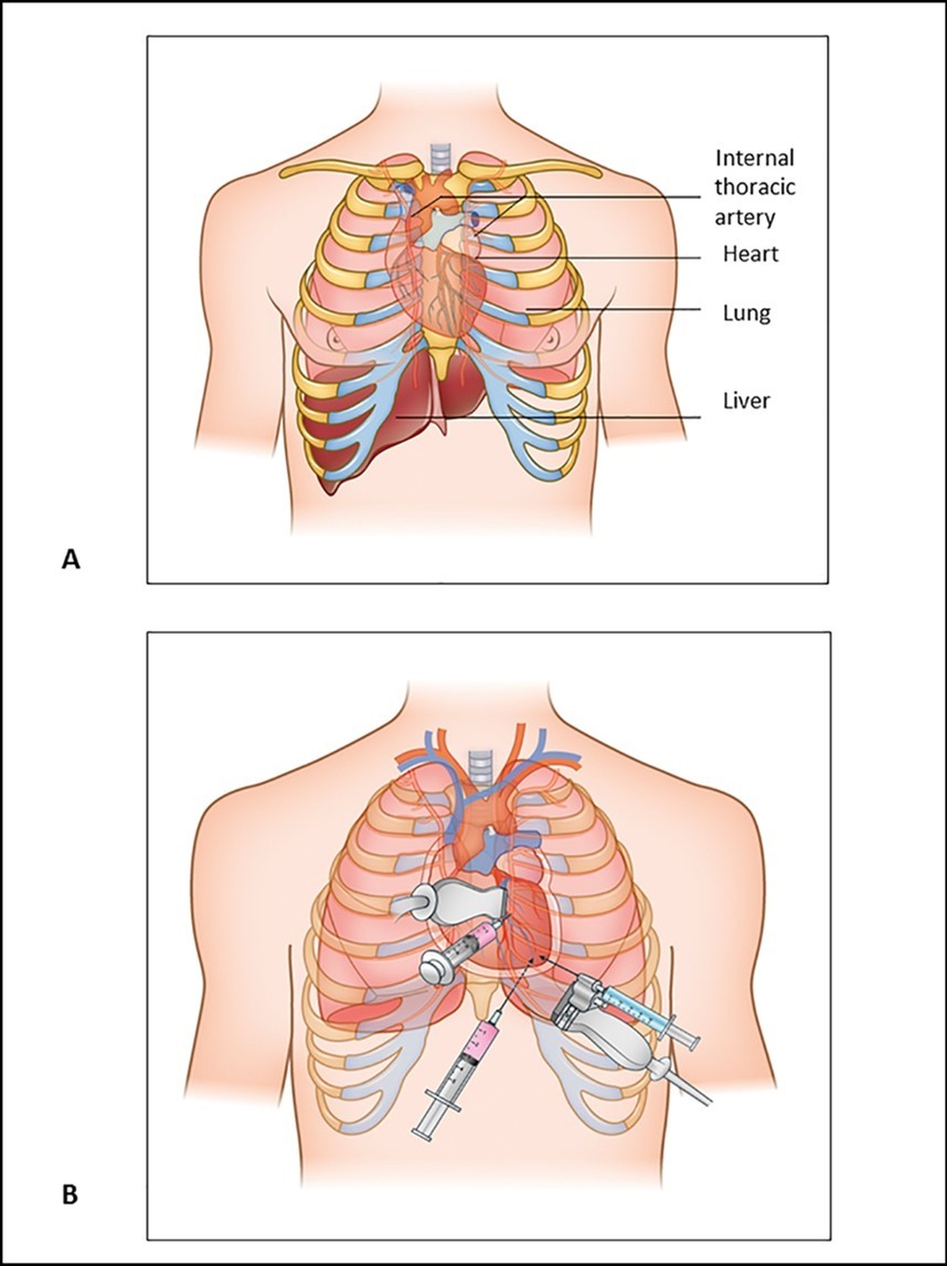 A. Anatomic structures to be taken care during pericardiocentesis procedure. B. Three main approaches for pericardiocentesis; a) Parasternal, b) Apical and               c) Substernal