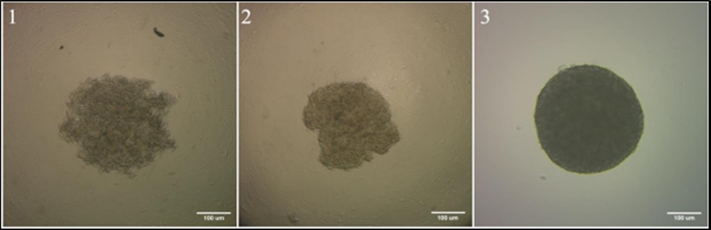 Stages of spheroid formation  1 - formation of tumor cells disc on the bottom of the well;                          2 - aggregation of tumor cells; 3 - compaction and growth of tumor cells. melanoma cell culture #912, 33 passage. Zeiss Primo Vert phase contrast microscope (10x 0.25 Ph1). The scale bar is 100 µm.