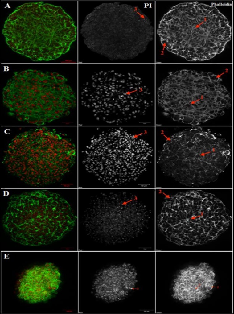 Confocal microscopy analysis of tumoroids’ structure    A – melanoma cell culture #912, B – myxofibrosarcoma cell culture #728, C –leiomyosarcoma cell culture #699, D – melanoma cell culture #226, E – breast cancer cell culture #973. PI - Propidium iodide (red, nuclei), Phalloidin-Alexa-488 (green, F-actin). Legend: arrow 1 indicates inner spheroid layer and F-actin outgrowths, arrow 2 indicates proliferating rounded cells at the spheroid periphery, arrow 3 indicates stained nuclei. Scale bar is 50 µm for cell cultures #699, #728, #226, 100 µm for cell              culture #912, #973.