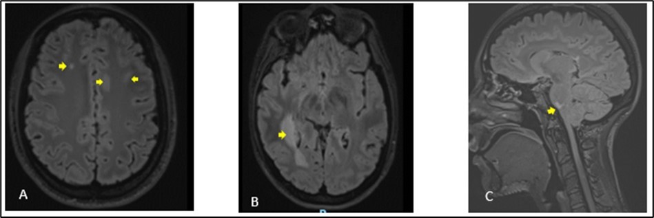 Cerebral MRI in FLAIR sequences showing multiple hyperintense lesions at the supratentorial (A, B) and infratentorial (C) levels. The largest supratentorial lesion (B) is opposite the right                            paraventricular white matter, at the level of the posterior horn and measures 55 x 17 mm axially.              Presence of a lesion of pons (C) of 6.5 mm.