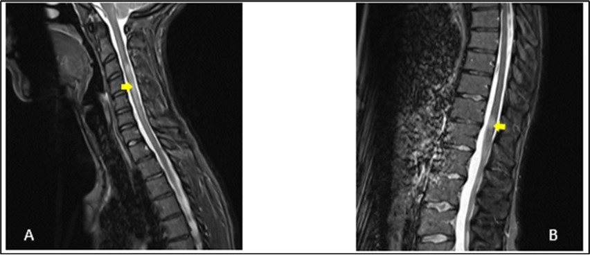 Sagittal T2-weighted spine MRI showing at cervical level (A), a spontaneous                 hyperintense lesion of 5 cm from C3 to C6 and at thoracic level (B), a spontaneous                           hyperintense lesion of 1.5 cm from T11-T12