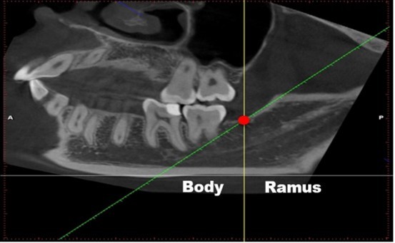 Image-reading position. (1) a horizontal line was made parallel to the lower edge of the mandible (grey line); (2) a tangent line of the front edge of the mandibular ramus (green line), which intersects with the upper edge of the mandibular body (Fig. 1, red circle); (3) a line across the intersection was made vertical to the line in (1) (Fig. 1, yellow line). We defined the following: the bifurcation that appears in front of this              vertical line (yellow line) is classified into mandibular body area, whereas the bifurcation that appears behind it is the mandibular ramus area (Fig. 1).