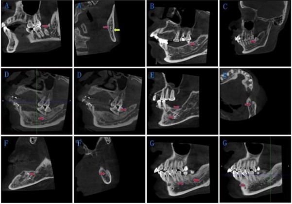 New classification of BMC: The red arrow points to the bifurcations, and the yellow arrow points to the mandibular canal. (A) Type IA: Bifurcations at the mandibular ramus, and retromolar foramen has been formed. (B) Type IB: Bifurcations at the               mandibular ramus, and retromolar foramen has not been formed. (C) Type II:                          Bifurcations at the mandibular body. (D)-(F) Type III: Bifurcations exist both at the mandibular body and the mandibular ramus on one side. (G) Type IV: Other circumstances.