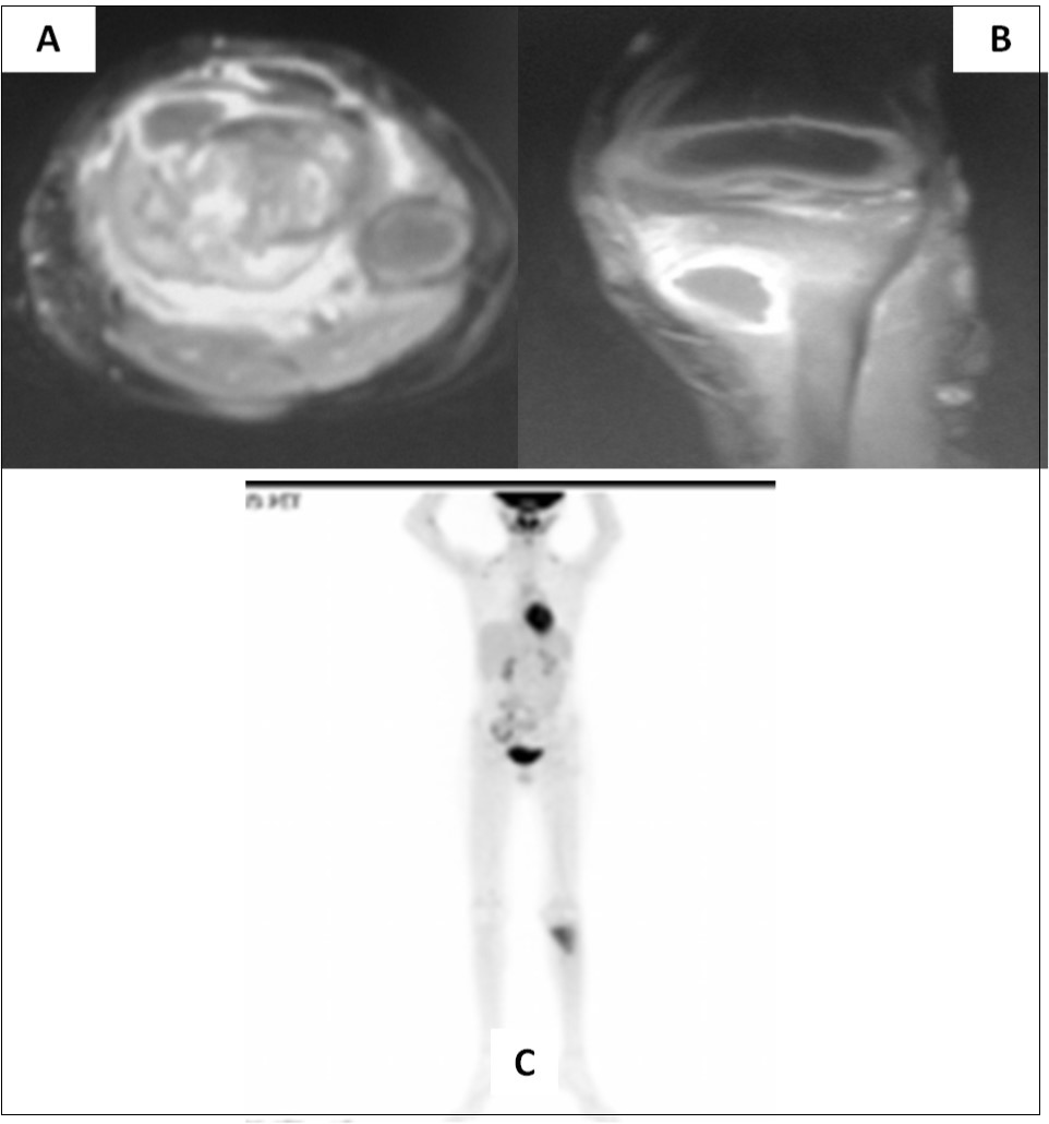 Axial (A) and coronal (B) MRI sections of left proximal tibia showing a large soft tissue component in addition to the lytic/sclerotic bony lesion. Whole body FDG-PET/CT showing increased tracer uptake localized to this lesion (C) with no significant abnormal uptake elsewhere in the body