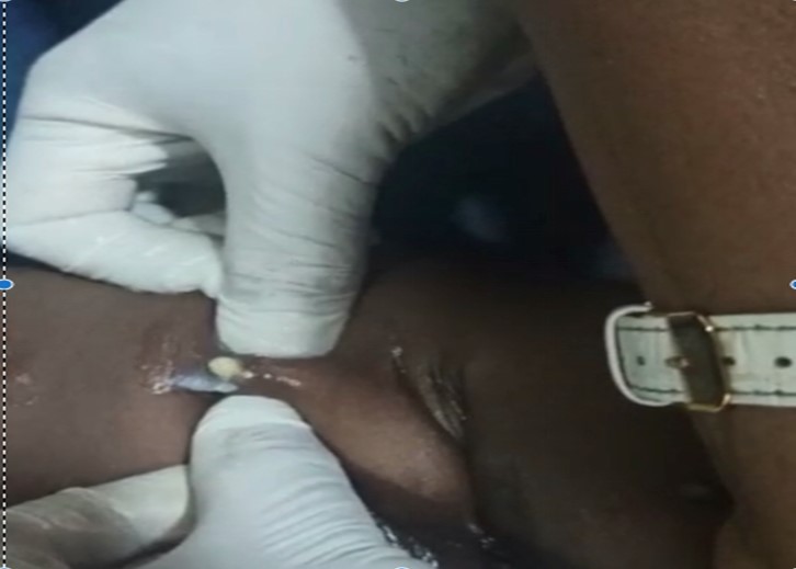 Teasing out the larvae after suffocating with petroleum jelly