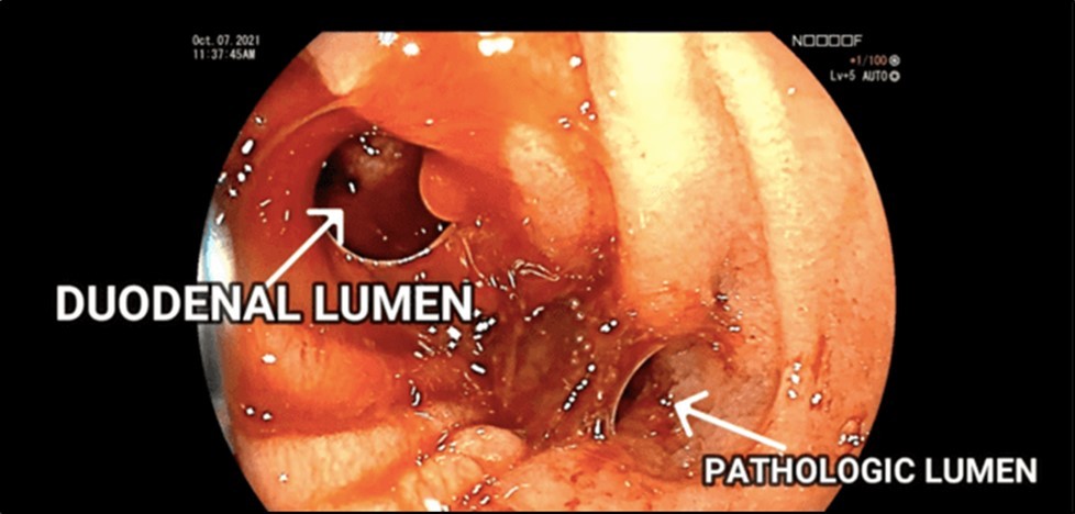 EGD findings of a pathologic lumen and a bleeding vessel were seen at the third portion of the            duodenum.