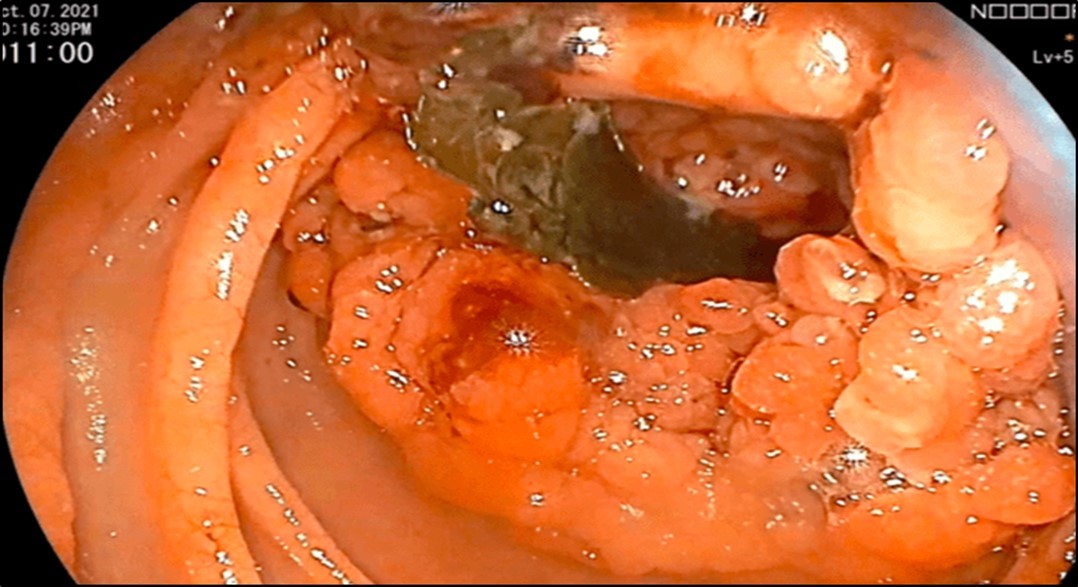 Colonoscopy finding of a circumferential, obstructive and nodular mass with areas of  necrosis with a pathologic lumen believed to be communicating with the lumen seen on the previous EGD was seen at the proximal transverse which precluded further advancement of the scope