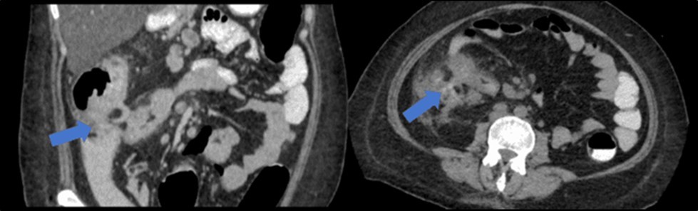 Coronal and axial view of the abdomen, the blue arrows pointing towards the suggestive                     communication to the ileum.