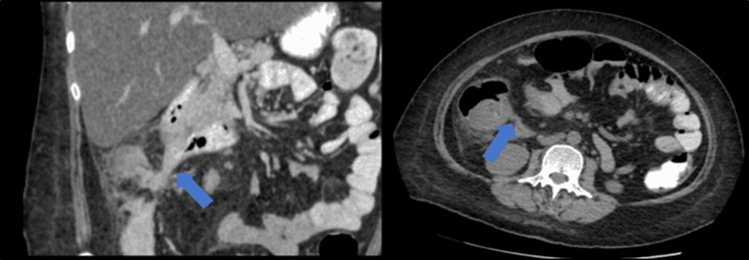 Coronal and axial view of the abdomen, the blue arrows pointing towards the suggestive             communication to the duodenum