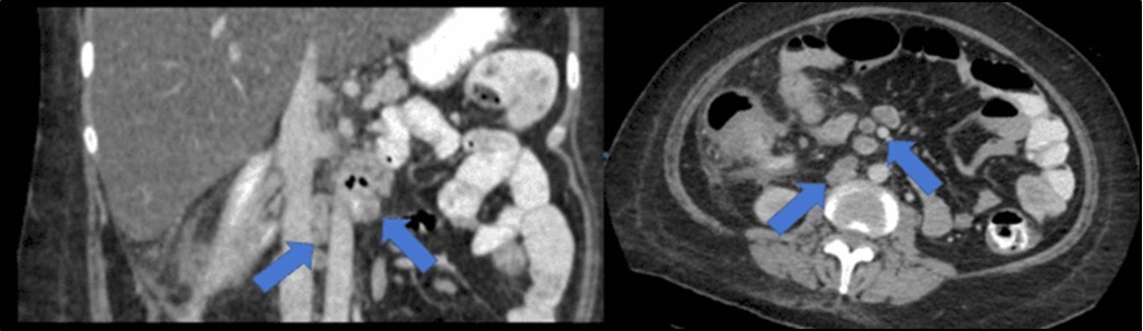 Enlarged and necrotic abdominal nodes in the mesenteric, pericecal, pericolic, para-aortic, paracaval and inter-aortocaval regions. Prominent and enlarged nodes also located in the common hepatic and periportal regions