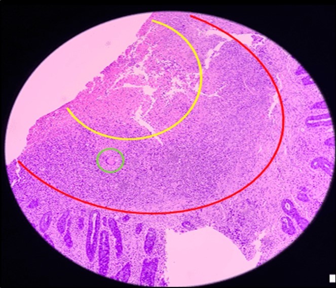 Pathologic slide in the low power field. The area inside the yellow circle is the area of central necrosis. The portion inside the red circle is the peripheral lymphocytic ring, and inside the green circle is the Langhan’s type multinucleated giant cells