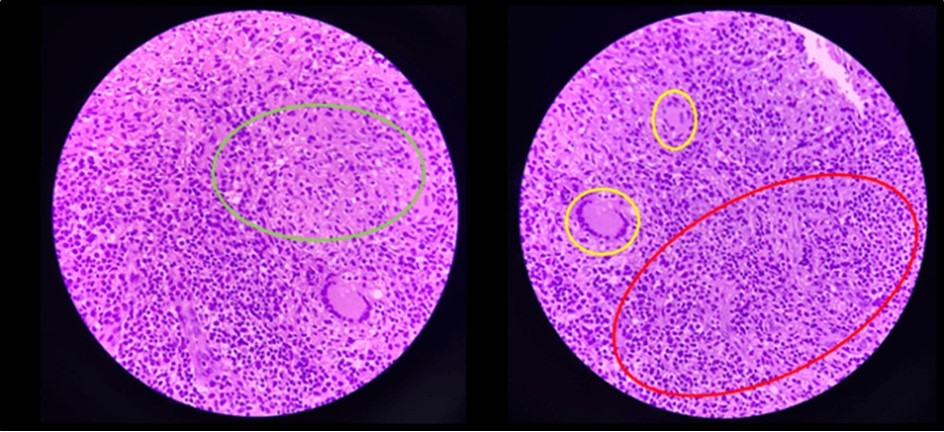 Pathologic slide in the high power field. Inside the green circle is the epitheloid histiocytes. The yellow circles are the Langhan’s type multinucleated gian cells. And inside the red circle is the                        lymphocytic infiltrates. Which is suggestive of tuberculous etiology.
