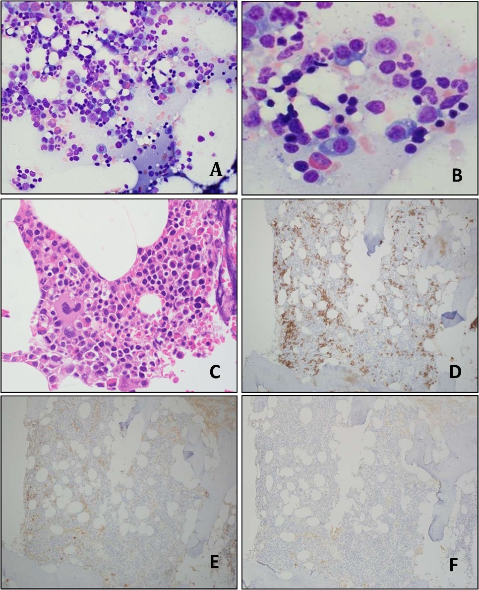 Bone marrow aspirate smear (A-B) and bone marrow biopsy (C) show normocellular bone              marrow with normal trilineage hematopoiesis and slightly increased plasma cells; blasts are not increased. Immunohistochemistry (IHC) performed on the bone marrow biopsy sections show the CD138-positive plasma cells are mildly increased in number, but <10% of all bone marrow nucleated cells (D); they are positive for lambda light chain (E), but negative for kappa light chain (F). (A, Wright-Giemsa stain, original magnification, × 400; B, Wright-Giemsa stain, original magnification, × 600;  C, H&E stain, original                   magnification, × 600; D-F, IHC stains, original magnification, × 100).