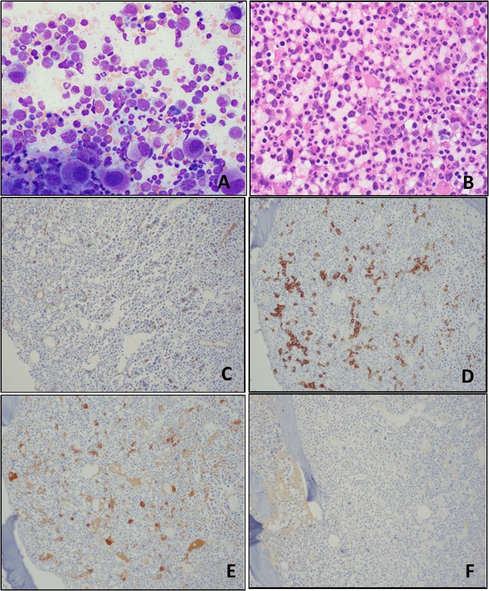 Bone marrow aspirate smear (A) and bone marrow biopsy (B) show markedly hypercellular bone marrow with granulocytic hyperplasia, erythroid hypoplasia, and megakaryocytic hyperplasia with “dwarf” megakaryocytes containing mono-/hypolobated nuclei; sheets of blasts are not seen. Immunohistochemistry (IHC) performed on the bone marrow biopsy sections show <5% CD34-positive blasts (C); CD138-positive plasma cells are <5% of all bone marrow nucleated cells (D); the plasma cells are positive for                lambda light chain (E), but negative for kappa light chain (F). (A, Wright-Giemsa stain, original magnification, × 400; B, H&E stain, original magnification, × 600;  C-F, IHC stains, original magnification, × 100).