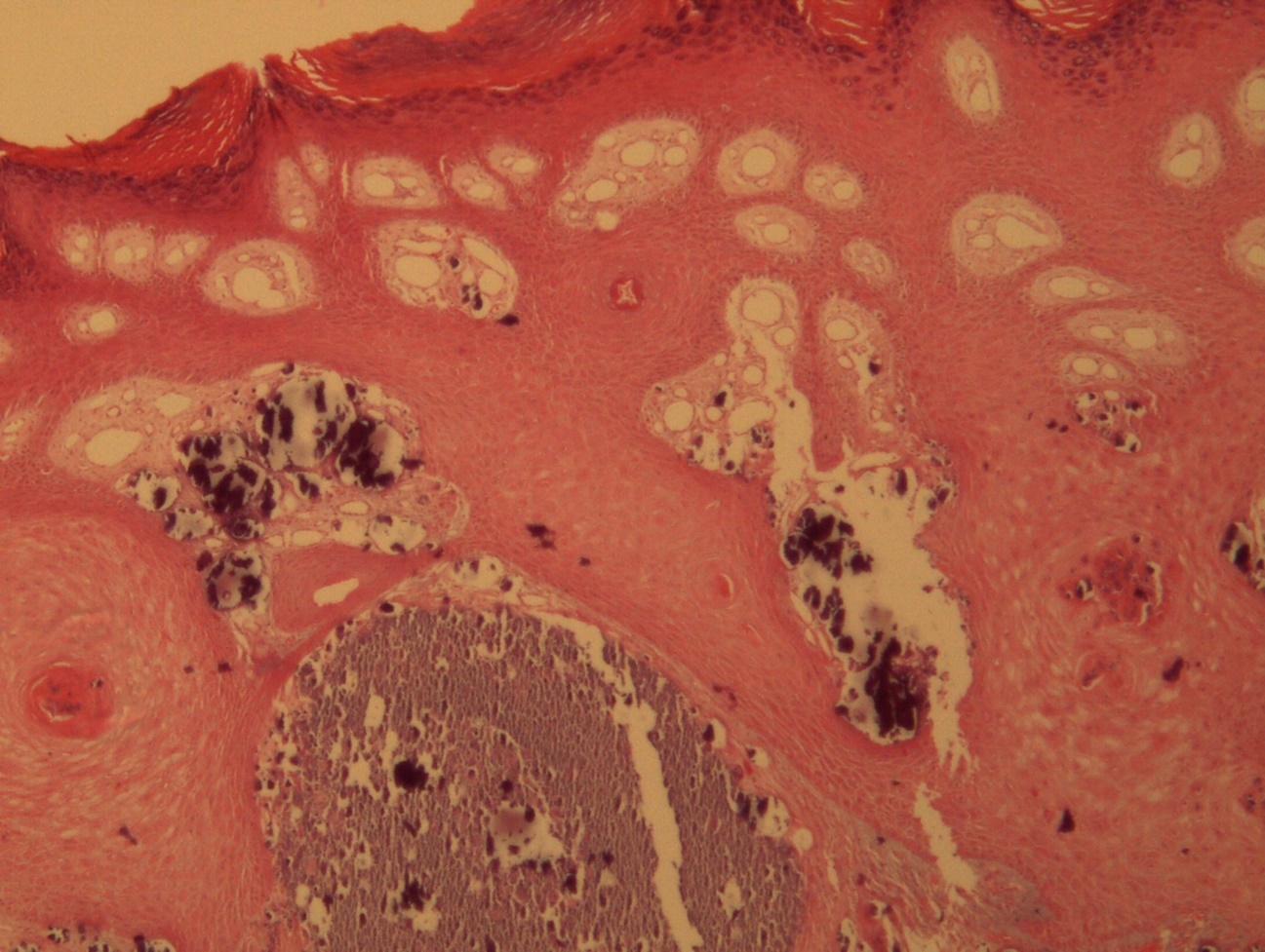 Hyperkeratosis, hypergranulosis, proliferation of dermal vessels, and surface and deep calcium deposits. HE. 100x.