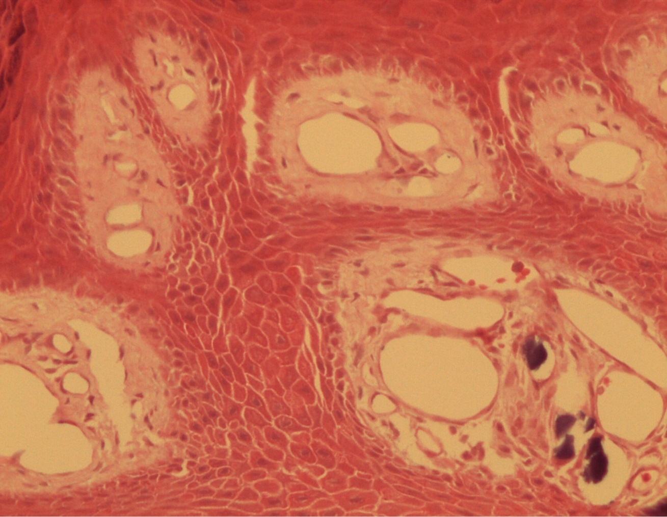 Presence of calcium deposits in the dermal vessels. Detail. HE 400x.