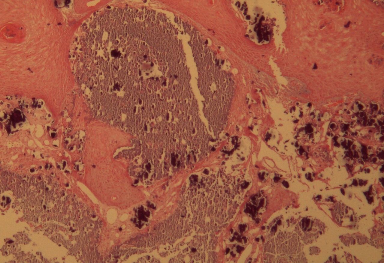 Calcium deposits. Detail. HE 200x.