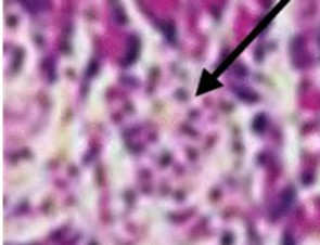 Photomicrograph of the pancreas from              diabetic control (DC) rats showing distorted Islet margin (arrow) with lymphocytic cells infiltration and moderate necrotic parenchyma (H &E stain X400 magnification)