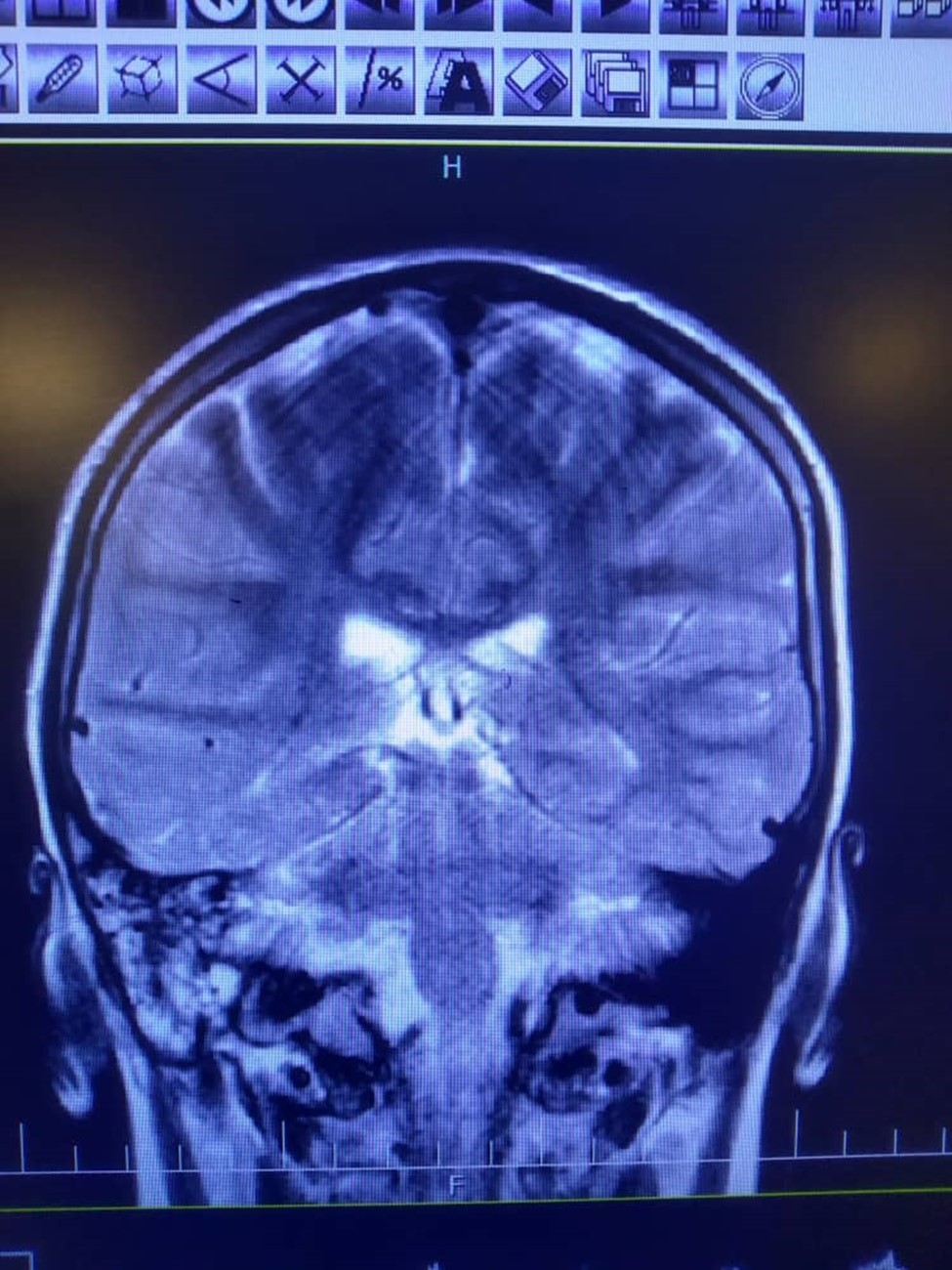High signal intensity in both hemispheres is noted suggestive of meningitis.  In T2 sequence there are hyper signal material left maxillary sinuse and bilateral frontal sinuses in favour of sinusitis, polyp and retention cyst in left maxillary sinus is noted. Effusion in right mastoidal air cell is noted.