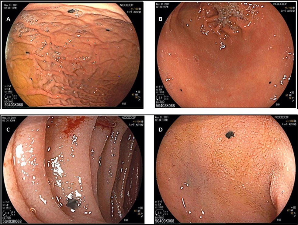 (A) Antrum (B) Gastric body (C) 2nd part of the Duodenum (D) Duodenal bulb