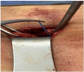 One of the offending pacing wires found adjacent to back of the xyphoid process. It is held with forceps.