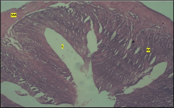 Low dose showing the lumen (l), smooth muscle layer (sm) and dysplasia of the mucosa (m). there is loss of epithelial shape H & E. X40.