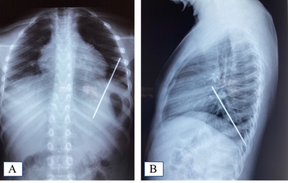 A. Frontal chest X-ray showing the foreign body; B: Foreign body sparing the diaphragm on the lateral chest X-ray