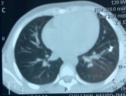 Foreign body in the left lower                    pulmonary lobe