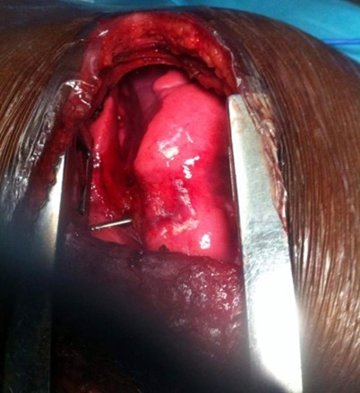 Foreign body visible within                     left lower pulmonary lobe through                     posterolateral thoracotomy